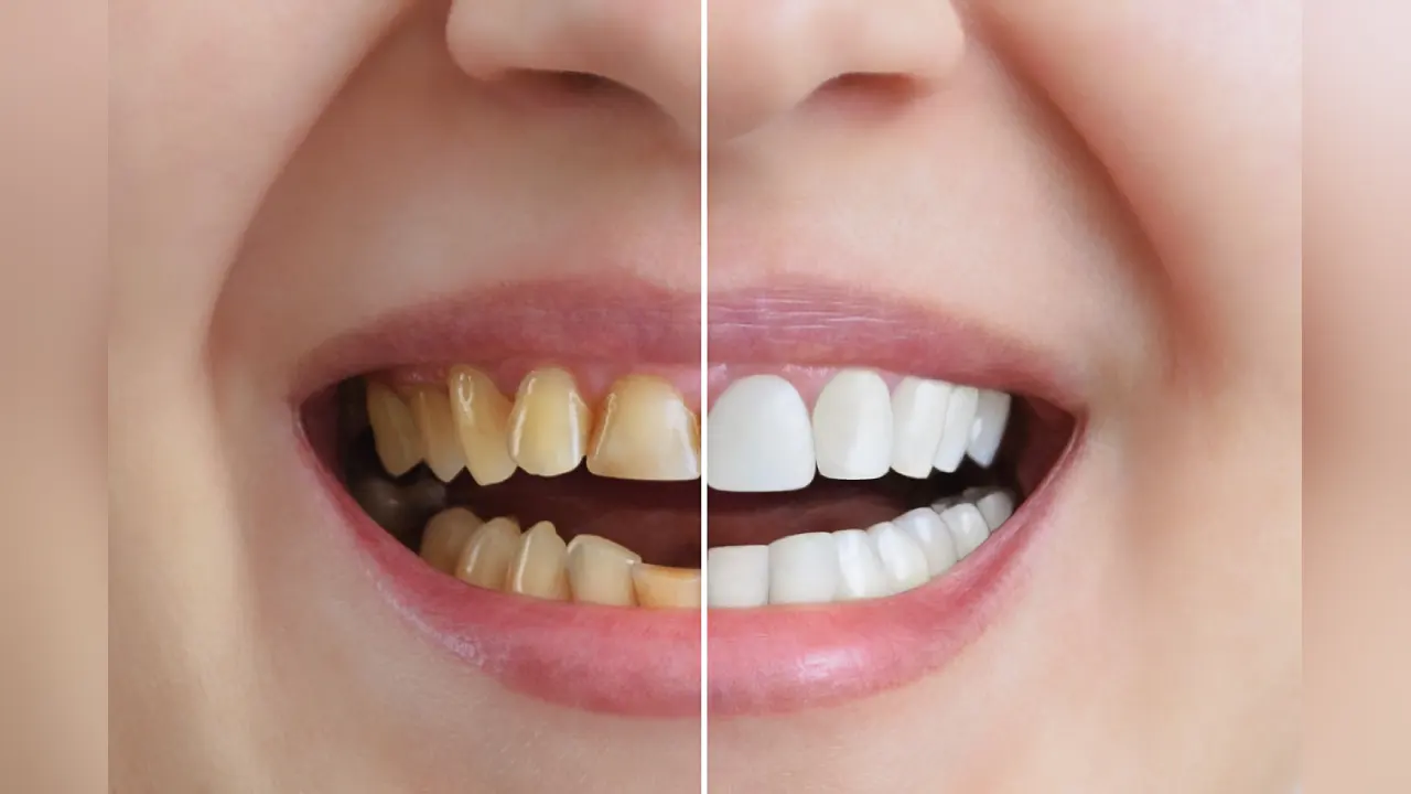 teeth whitening tips, health and fitness, oral health tips, dentist tips,