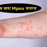 Mpox Virus