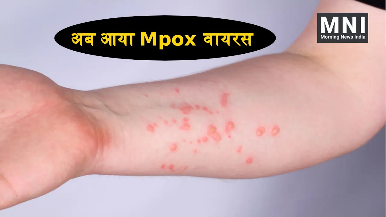 Mpox Virus